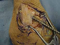 تثبيت الطعم باستخدام البراغي التداخلية الحيوية