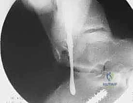 صورة توضيحية لـ إعادة بناء أربطة الكاحل الجانبية بالطعوم: حل نهائي لعدم الاستقرار المزمن مع الأستاذ الدكتور محمد هطيف