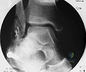 صورة طبية: إعادة بناء أربطة الكاحل الجانبية بالطعوم: حل نهائي لعدم الاستقرار المزمن مع الأستاذ الدكتور محمد هطيف