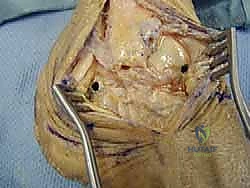 صورة توضيحية لـ إعادة بناء أربطة الكاحل الجانبية بالطعوم: حل نهائي لعدم الاستقرار المزمن مع الأستاذ الدكتور محمد هطيف