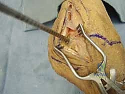 إعادة بناء أربطة الكاحل الجانبية بالطعوم: حل نهائي لعدم الاستقرار المزمن مع الأستاذ الدكتور محمد هطيف