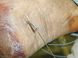 تجهيز الطعم الجراحي بدقة ميكروسكوبية