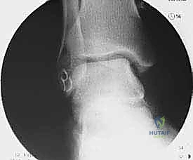 صورة طبية: إعادة بناء أربطة الكاحل الجانبية بالطعوم: حل نهائي لعدم الاستقرار المزمن مع الأستاذ الدكتور محمد هطيف