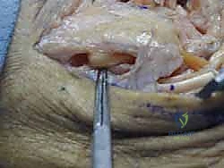 صورة طبية: إعادة بناء أربطة الكاحل الجانبية بالطعوم: حل نهائي لعدم الاستقرار المزمن مع الأستاذ الدكتور محمد هطيف