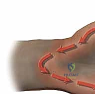 صورة توضيحية لـ علاج التهابات اليد العميقة: دليل شامل من الأستاذ الدكتور محمد هطيف في صنعاء