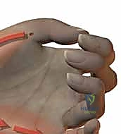 صورة توضيحية لـ علاج التهابات اليد العميقة: دليل شامل من الأستاذ الدكتور محمد هطيف في صنعاء