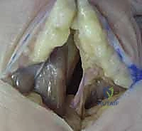 أسباب التهابات اليد العميقة وتأثيرها على الأنسجة