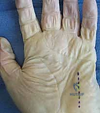 صورة توضيحية لـ علاج التهابات اليد العميقة: دليل شامل من الأستاذ الدكتور محمد هطيف في صنعاء