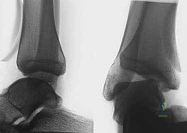 توضيح طبي: بداية التدخل الجراحي وعمل الشق الجراحي بدقة متناهية