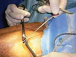 توضيح طبي: تمرير الوتر (الرقعة) عبر الأنفاق العظمية لمحاكاة الأربطة الطبيعية