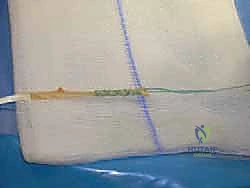 توضيح طبي: تجهيز الأنفاق العظمية في عظمة الكاحل (Talus) وعظمة الكعب (Calcaneus)