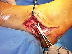 توضيح طبي: استكمال عملية التثبيت الميكانيكي القوي للوتر في عظام الكاحل