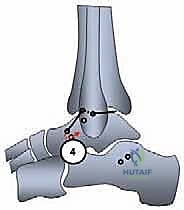 توضيح طبي: الكاحل في فترة التعافي الأولية مع وضع الضمادات المعقمة