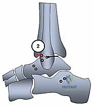 توضيح طبي: خياطة الأنسجة المحيطة لتعزيز الثبات (Retinaculum Repair)
