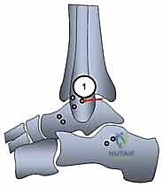 توضيح طبي: اختبار ثبات الكاحل أثناء العملية بعد تثبيت الأربطة الجديدة