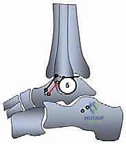 توضيح طبي: الشكل النهائي للكاحل بعد إغلاق الجرح ونجاح عملية إعادة البناء