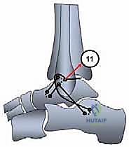 Illustration of plantaris longus tendon - Dr. Mohammed Hutaif