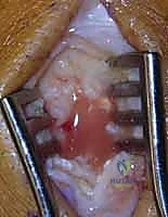 Septic Arthritis of the Hand and Wrist: An Intraoperative Drainage Masterclass