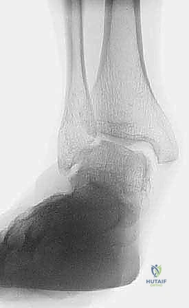 أسباب تمزق وضعف الرباط الدالي للكاحل