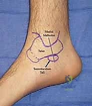 تشخيص إصابات الرباط الدالي باستخدام أحدث التقنيات