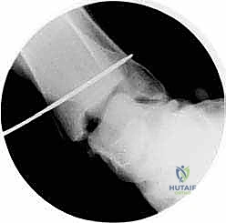 التحضير لعملية إعادة بناء الرباط الدالي