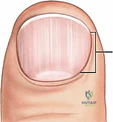 إصابات السحق وتأثيرها على الظفر