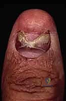 خياطة الأنسجة الدقيقة