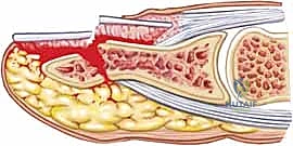 التشخيص السريري لإصابات الأظافر