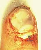 التعامل مع الأورام تحت الظفر