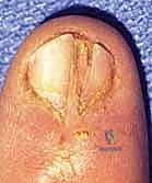 تحديد منطقة الاستئصال