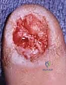 الخياطة النهائية للرقعة