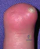 الاستئصال الجراحي الدقيق للمصفوفة