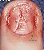 تثبيت الرقعة في مكان الإصابة