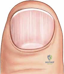 إزالة صفيحة الظفر بحذر