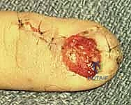 تمزقات سرير الظفر المعقدة