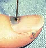 تجمع دموي تحت الظفر