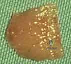 متابعة التئام الجرح