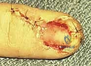 تشريح مصفوفة الظفر والأنسجة المحيطة