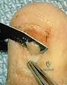 صورة توضيحية لـ إصلاح وإعادة بناء واستئصال مصفوفة الظفر: دليل شامل للمرضى مع الأستاذ الدكتور محمد هطيف