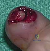 صورة توضيحية لـ إصلاح وإعادة بناء واستئصال مصفوفة الظفر: دليل شامل للمرضى مع الأستاذ الدكتور محمد هطيف