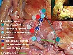 صورة توضيحية لـ إعادة بناء أربطة الكاحل الإنسية ورباط الدالية