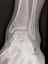 تمزق أربطة الكاحل الإنسية