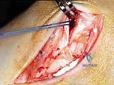 صورة طبية: إعادة بناء أربطة الكاحل الإنسية ورباط الدالية: استعادة الاستقرار والحركة في صنعاء مع الأستاذ الدكتور محمد هطيف