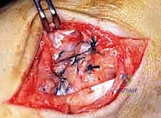 صورة طبية: إعادة بناء أربطة الكاحل الإنسية ورباط الدالية: استعادة الاستقرار والحركة في صنعاء مع الأستاذ الدكتور محمد هطيف