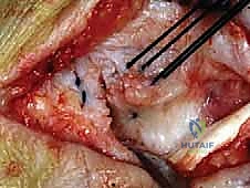 صورة طبية: إعادة بناء أربطة الكاحل الإنسية ورباط الدالية: استعادة الاستقرار والحركة في صنعاء مع الأستاذ الدكتور محمد هطيف