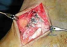 صورة طبية: إعادة بناء أربطة الكاحل الإنسية ورباط الدالية: استعادة الاستقرار والحركة في صنعاء مع الأستاذ الدكتور محمد هطيف