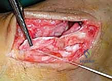 صورة طبية: إعادة بناء أربطة الكاحل الإنسية ورباط الدالية: استعادة الاستقرار والحركة في صنعاء مع الأستاذ الدكتور محمد هطيف