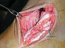 تمرير الرقعة الوترية في العظم