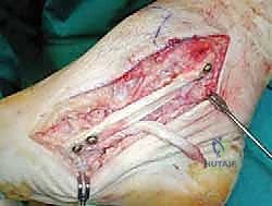 صورة طبية: إعادة بناء أربطة الكاحل الإنسية ورباط الدالية: استعادة الاستقرار والحركة في صنعاء مع الأستاذ الدكتور محمد هطيف