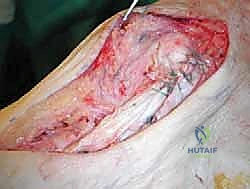 صورة طبية: إعادة بناء أربطة الكاحل الإنسية ورباط الدالية: استعادة الاستقرار والحركة في صنعاء مع الأستاذ الدكتور محمد هطيف